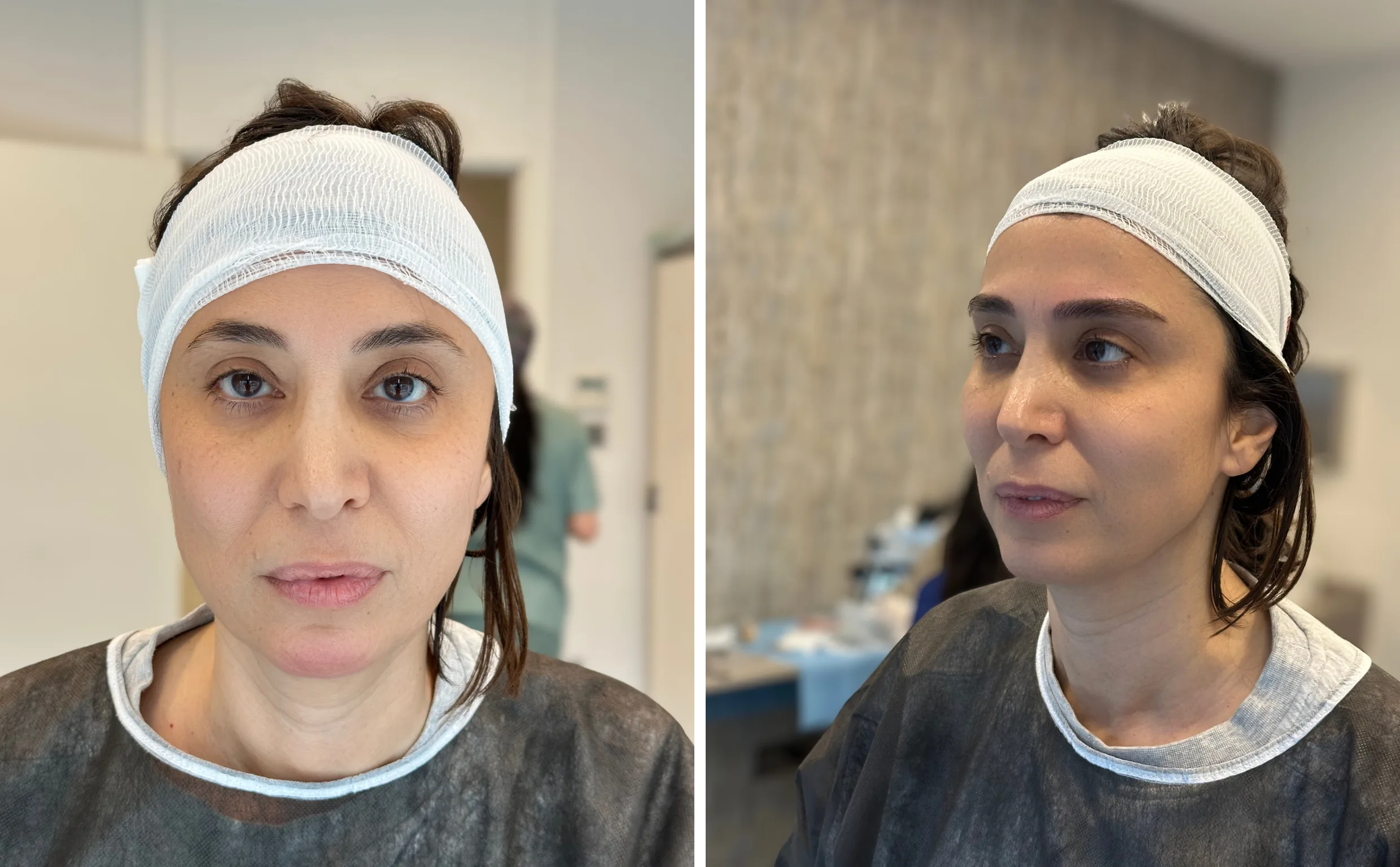 Solda başı sargılı hasta önden, sağda aynı hastanın aynı gün dörtte üç profilden görünümü.