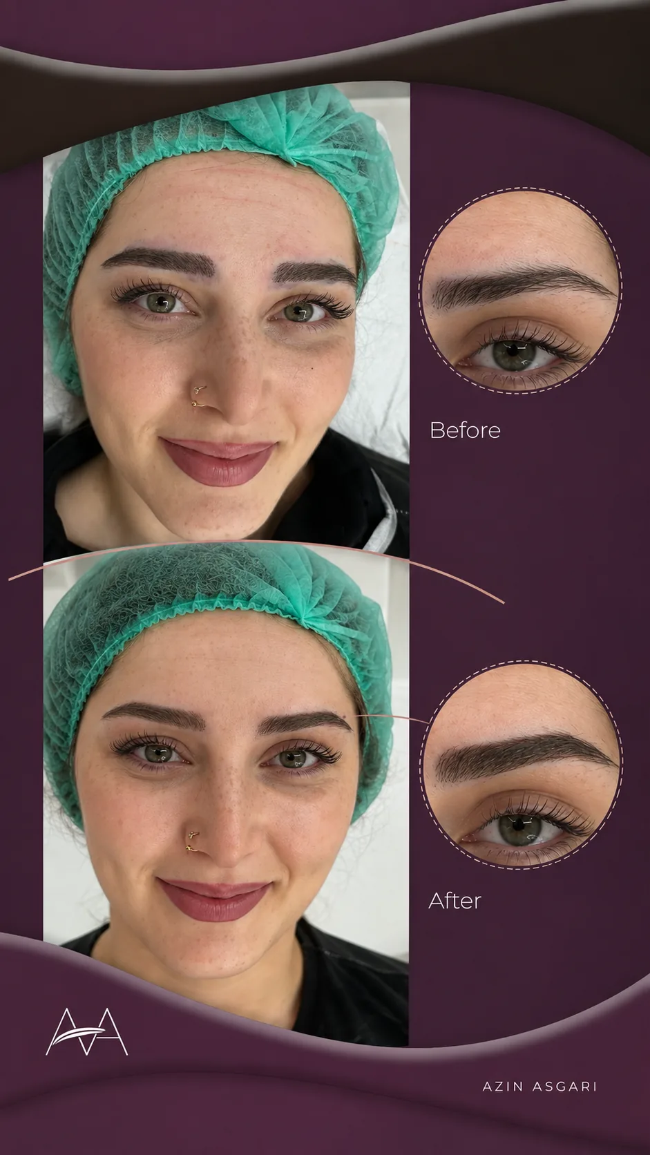 Üstte ekimden önceki kaşlar, altta ekimden sonraki hâli; yandaki dairelerde aynı kaşın yakın planı. Her iki karede de yeşil cerrahi bone var.